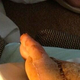 Illustration for article titled Snakebite Victims Post-Surgery Foot Is Still Horrifying (NSFW)